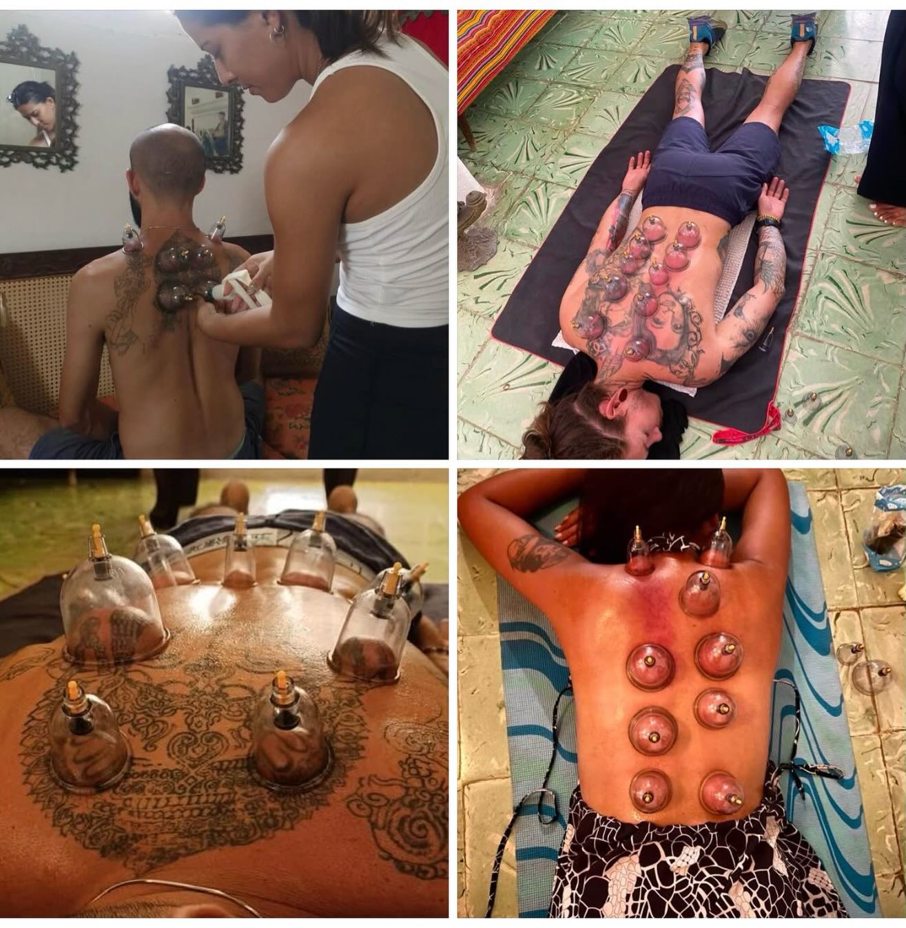 La terapia con ventosas consiste en colocar unas copas especiales sobre la piel para crear un efecto de succión. Se utiliza en diversos sistemas de medicina tradicional y también por algunos fisioterapeutas y especialistas en medicina deportiva.

Existen varios tipos comunes de ventosas:

* Ventosas secas: Las copas crean succión mediante calor o una bomba de vacío. Permanecen sobre la piel entre 5 y 20 minutos.
* Ventosas húmedas: Después de realizar pequeñas punciones superficiales en la piel, se colocan las ventosas para extraer una pequeña cantidad de sangre. Este procedimiento debe ser realizado únicamente por profesionales capacitados y bajo condiciones estériles.
* Ventosas deslizantes (o de masaje): Se aplica aceite sobre la piel y las ventosas se deslizan por el cuerpo mientras mantienen la succión.

Las personas utilizan la terapia con ventosas por diversas razones, entre ellas:

* Aliviar el dolor y la tensión muscular.
* Reducir el dolor de cuello, hombros y espalda.
* Favorecer la recuperación deportiva.
* Promover la relajación.

¿Funciona?

Algunas personas informan un alivio temporal del dolor y la rigidez muscular después de recibir terapia con ventosas./Cupping is a therapy in which special cups are placed on the skin to create suction. It’s used in some traditional medicine systems and by some physical therapists or sports medicine practitioners.
 Translate to Spanish 
There are a few common types:

* Dry cupping: Cups create suction using heat or a pump. They remain on the skin for 5–20 minutes.
* Wet cupping: After light, superficial skin pricks, cups are applied to draw out a small amount of blood. This should only be performed by trained practitioners under sterile conditions.
* Massage (moving) cupping: Oil is applied to the skin, and the cups are moved over the body while maintaining suction.

People use cupping for reasons such as:

* Muscle soreness and tightness
* Neck, shoulder, and back pain
* Sports recovery
* Relaxation